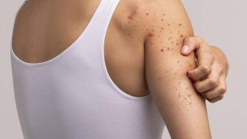 Imagem mostrando o braço de uma pessoa com várias manchas vermelhas, possivelmente sinais de alergia. Outra pessoa está tocando suavemente o braço da pessoa afetada.